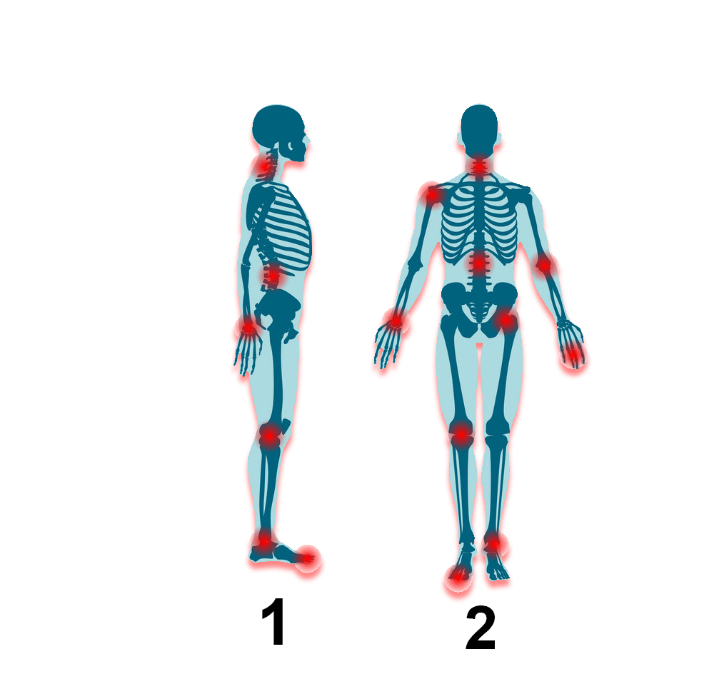 Rheumatism What to do if arthritis or old arthritis?